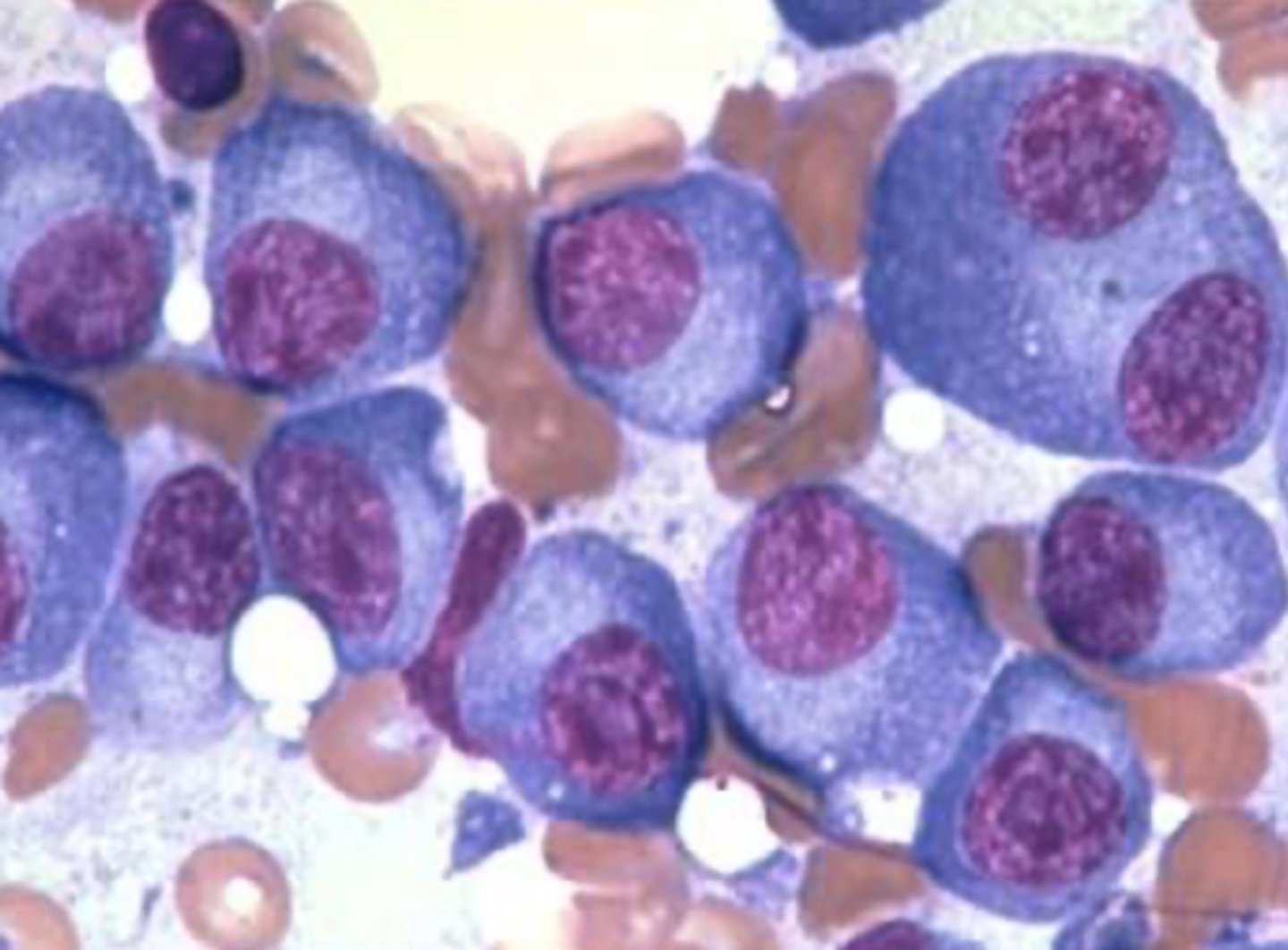 <p>Plasma cells have purplish nuclei with blue cytoplasm</p><p>--&gt; multiply and choke out regular WBCs</p><p>- red cells = erythrocytes</p>