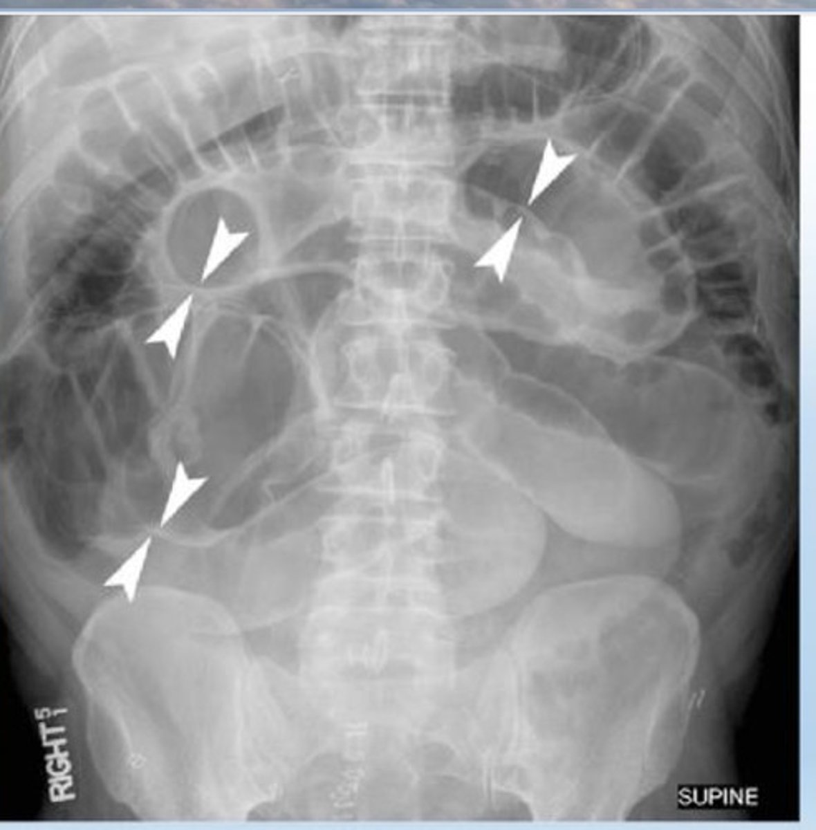 <p>"double wall sign"; pneumoperitoneum may cause both sides of bowel wall to be visible; get CXR if you suspect pneumoperitoneum for air under diaphragm on an erect</p>