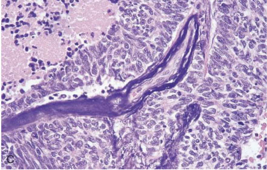 <p>small cell carcinoma</p>