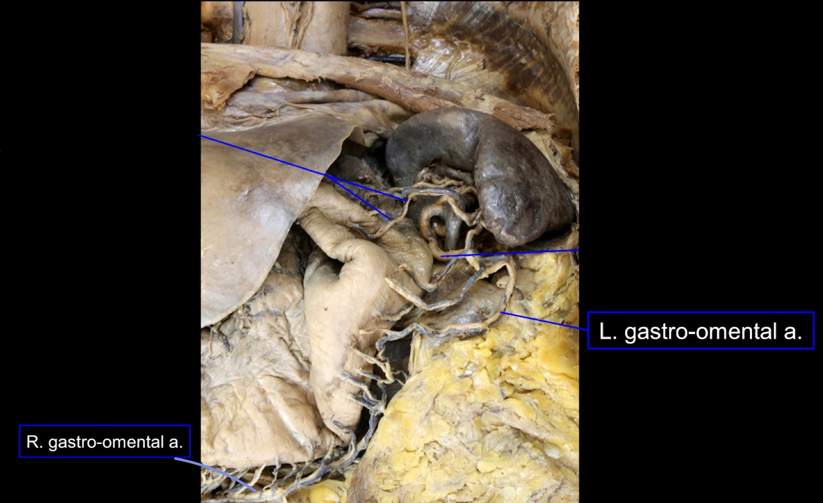 <p>A). left gastroomental artery<br>B). right gastroomental artery</p>