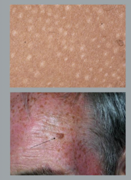 <p>small circumscribed area of change in skin color w/o elevation or depression</p>