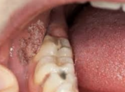 <p>Aandoening gerelateerd een hiv en is een infectieuze aandoening. Klinisch wordt de aandoening gekenmerkt door een onregelmatige worstvormige verdikking van een mondslijmvlies, meestal aan de binnenzijde van de wang of overgang van wang naar </p><p>lip. Het wordt chirurgisch verwijderd.</p>