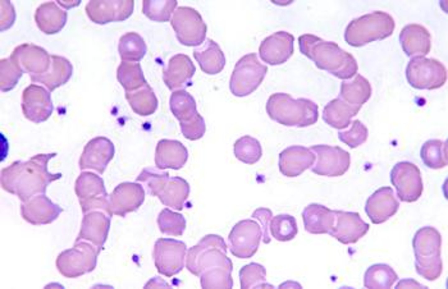 <p>The arrangement of erythrocytes on this peripheral blood smear can be associated with each of the following conditions EXCEPT:</p><p>Multiple myeloma</p><p>Cold agglutinin disorders</p><p>Chronic inflammatory disorders</p><p>Lymphoplasmacytic lymphoma</p>
