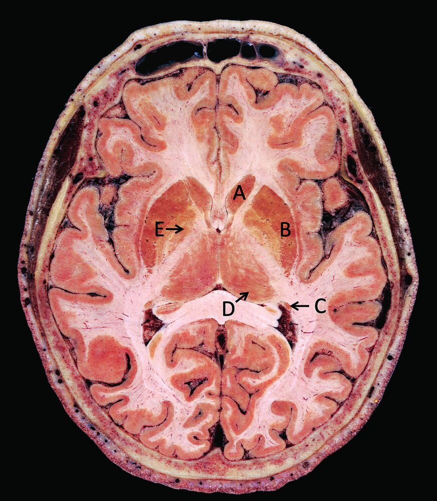 <p>66. Which letter marks the pulvinar of the thalamus in the brain section shown?</p><p>A. A</p><p>B. B</p><p>C. C</p><p>D. D</p><p>E. E</p>