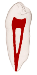 <p>(2-1)</p><p><span>two separate canals leave the pulp chamber and join short of the apex to form one canal</span></p>