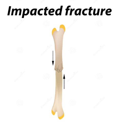 An impact fracture occurs when a sudden and intense force is applied directly to a bone, causing it to break. This type of fracture is often the result of a high-impact collision or fall, such as in car accidents or sports injuries.