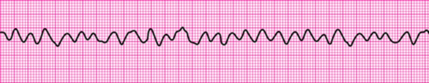 <p>Ventricular fibrillation</p>