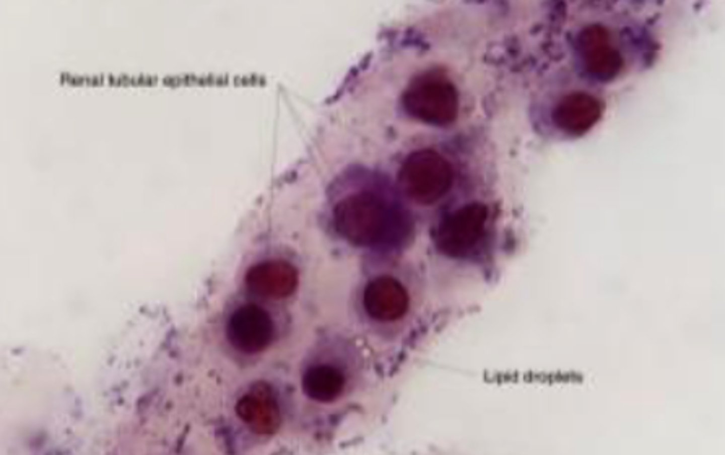 <p>- Picked up from cell walls or tubule walls</p><p>- Stay in tubules long enough → degenerates into coarse granular cast then fine granular cast</p><p>- Indicates renal cell necrosis or tubular damage</p>