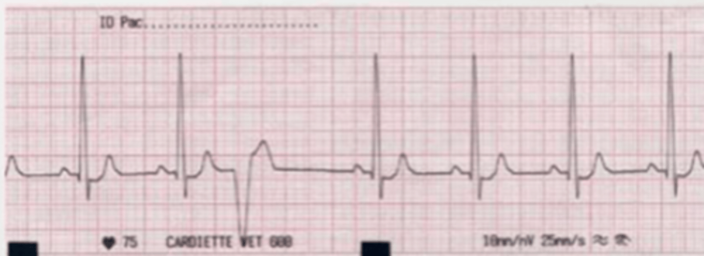 <p>what is the problem with this ECG? what does this mean?</p>