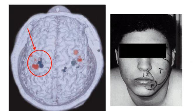 <p>when patients lose a limb they can start experiencing phantom limb pain, due to _______- as arm and face regions start to fused together ipsilatearl to lost limb </p>