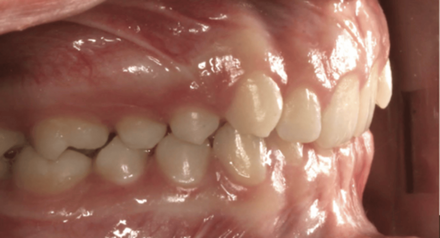 <p>Class II division 2</p>