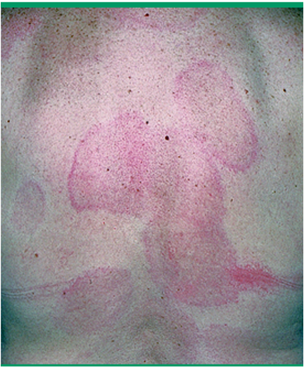 <p>edema w/in cutaneous vascular plexus of papillary body</p><p>caused by: insect bites, stings, meds, foods, infx</p>