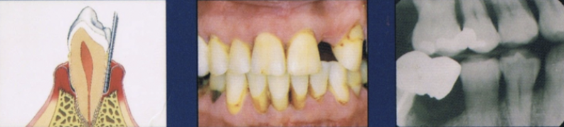 <ul><li><p>More advanced stage of previous condition</p></li><li><p>Increased destruction of periodontal structures</p></li><li><p><strong>Noticeable bone loss</strong>, support, and increase in <strong>mobility</strong></p></li><li><p><strong>Furcation</strong> involvement </p></li></ul><p></p>