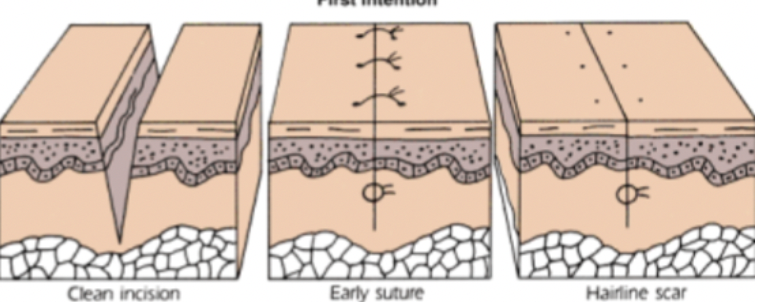 <ul><li><p>surgical site</p></li></ul>