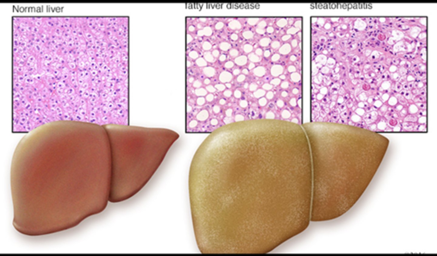 <p>Drug, Alcoholic, and Nonalcoholic Liver Disease</p>