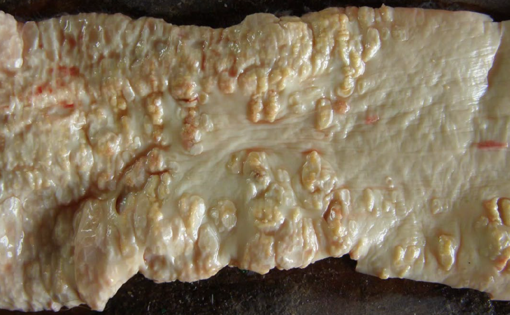 <p>A-Hemorrhagic colitis</p><p>B-Pseudomembranous enteritis</p><p>C-Catarrhal typhlitis</p><p>D-Granulomatous enteritis</p>