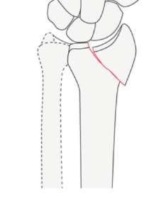 <p>Goes into the joint surface</p>