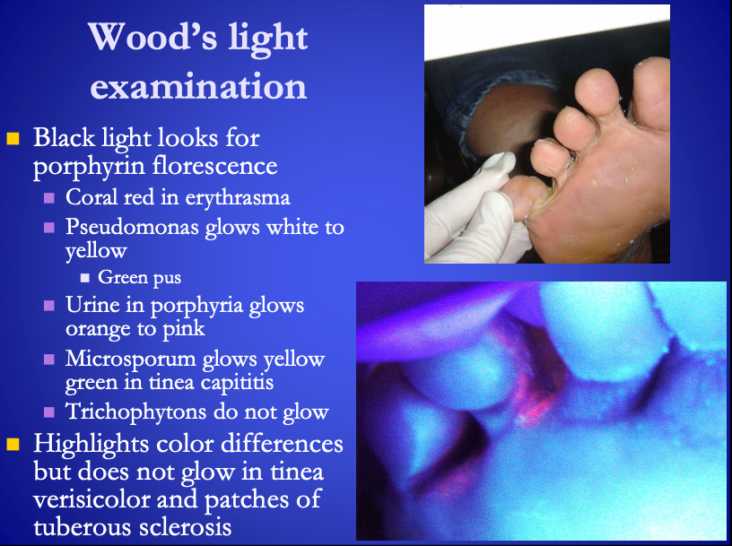 <p>Wood’s light examination</p><ul><li><p>Examples<br></p><ul><li><p>Detects <span>coral-red</span> florescence of Corynebacteria minuitissium in erythrasma</p></li><li><p>Pseudomonas glows <span>white to yellow</span></p></li><li><p>Urine glows <span>orange to pink</span></p></li><li><p>Microsporum in tinea capititis glows <span><strong>[...]</strong></span></p></li><li><p>Trichophytons <span>do not glow</span></p></li><li><p>Tinea verisicolor and patches of tuberous sclerosis <span>do not glow</span></p></li></ul></li></ul><p></p>