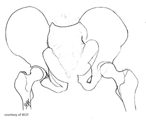 <p>Radiographic hallmark of an anteroposterior compression ("open-book") fracture?</p>
