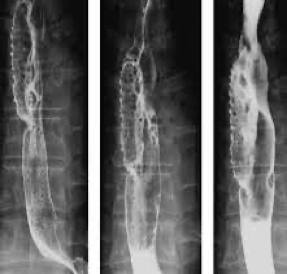 <p>causes burning chest pain- mimic heart attack</p><p></p>