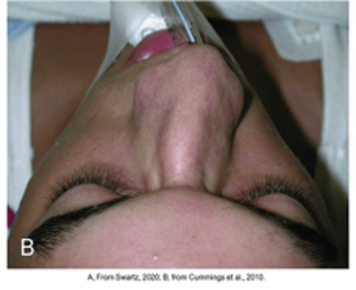 <p>Deviated septum treatment?</p>