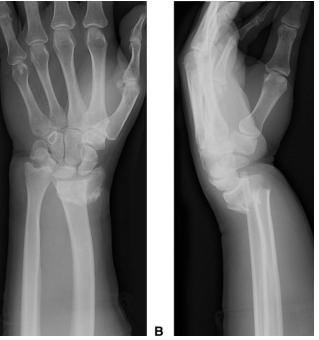 <p>Describe the alignment of this fracture </p>