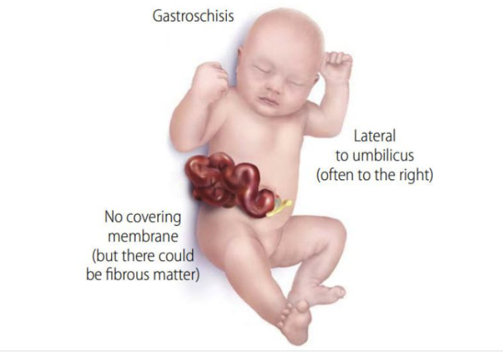 <p><span><strong>Gastroschisis</strong></span></p><p></p><p><span>The lateral folds fail to fuse, resulting in the herniation of abdominal contents<br>The herniated intestines are not covered in peritoneum, which could irritate the abdominal cavity</span></p><p></p>