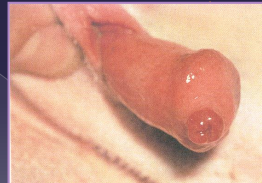 <ul><li><p><span><strong>Stones</strong></span></p><ul><li><p><span style="color: rgb(136, 136, 136);"><strong>Et: </strong></span><span>Bladder stones lodged in urethra</span></p><ul><li><p><span>distal urethra, just proximal to os penis</span></p></li></ul></li><li><p><span style="color: rgb(136, 136, 136);"><strong>Sig:</strong> </span><span>Males &gt; females</span></p></li><li><p><span style="color: rgb(136, 136, 136);"><strong>Tx:</strong> </span><span><u>urohydropulsion</u>, cystotomy</span></p><ul><li><p><span><strong><u>complete obstruction = EMERGENCY</u></strong></span></p></li></ul></li></ul></li><li><p><span><strong>Urethral Trauma</strong></span></p><ul><li><p><span style="color: rgb(136, 136, 136);"><strong>Laceration:</strong> </span><span>usually heal w/ urinary diversion (catheter ≥ 7d)</span></p></li><li><p><span style="color: rgb(136, 136, 136);"><strong>Transection:</strong> </span><span>primary anastomosis, urethrostomy</span></p></li></ul></li><li><p><span><strong>Urethral Prolapse</strong></span></p><ul><li><p><span style="color: rgb(136, 136, 136);"><strong>Et:</strong> </span><span>excitement, chronic irritation, infection</span></p></li><li><p><span style="color: rgb(136, 136, 136);"><strong>Sig:</strong></span><span> Bulldogs</span></p></li><li><p><span style="color: rgb(136, 136, 136);"><strong>Cs:</strong></span><span><strong> </strong>bleeding from urethra, visible prolapse</span></p></li><li><p><span style="color: rgb(136, 136, 136);"><strong>Tx: </strong></span><span>Urethral resection, Urethropexy, <strong><u>castrate</u></strong></span></p></li></ul></li></ul><p></p>