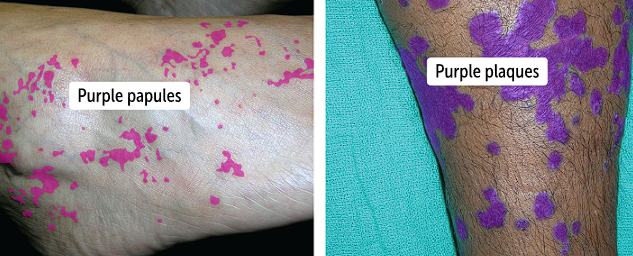 <p>Lichen planus is a chronic inflammatory disease that can <strong>impact skin, nails or oral mucosa, </strong>and has the 6 Ps to describe it</p><ul><li><p>Pruritic (itchy), purple, polygonal, planar, papules and plaques </p></li><li><p>Lichen planus papules can range from pink to violate papules that coalesce to form plaques</p></li></ul><p></p>