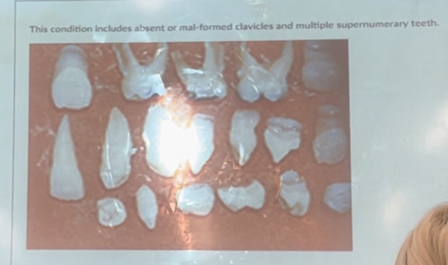 <p>This conditions includes absent or malformed clavicles and multiple supernumerary teeth.</p>