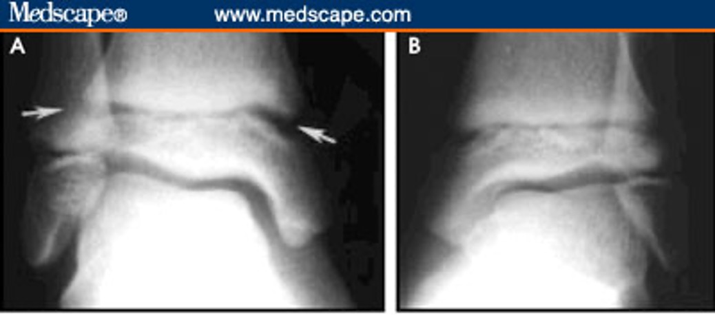 <p>what type of salter Harris fracture is this? what kind of tx is needed?</p>