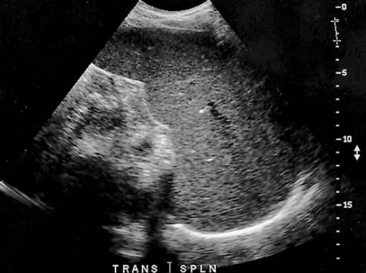 <p>a patient presents with history of alcohol abuse. Which splenic pathology is most likely identified here</p>