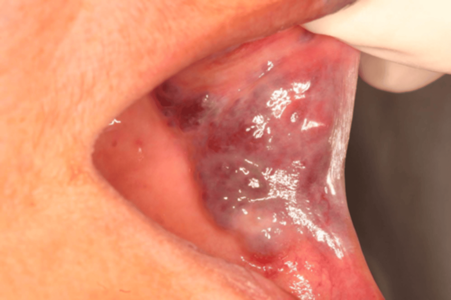 <p>Patient presents with a dark purple, port-wine stain macule on the buccal mucosa. Patient claims that is has been there all his life, it was present when he was born. What is the diagnosis?</p>