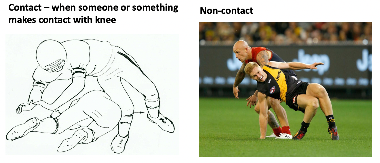 <ul><li><p>contact vs non-contact mechanisms</p></li><li><p>ACL is watchdog of knee → major static stabilizer</p></li><li><p>MOI: valgus loading w tibial rotation; and or/ anterior tibial displacement (driven forward), or hyperextension</p></li><li><p>Prevalence: </p><ul><li><p>25%: damage is isolated to ACL</p></li><li><p>60%: meniscal damage (medial and/or lateral)</p></li><li><p>30%: articular cartilage damage</p></li><li><p>30%: damage to collateral ligaments, joint capsule, or a combination of injuries</p></li></ul></li><li><p>S/S: heard/felt pop, rapid hemarthrosis: swelling in joint (golden period), stiff, warm and extremely painful</p><ul><li><p>Hemarthrosis: joint inflammation followed by muscle guarding (protective spasm)</p></li><li><p>Golden peiod: 15-30 min window</p></li></ul></li><li><p>Surgical reconstruction for athletes: restores stability</p></li><li><p>Conservative management: Not very effective → chronic ACL deficiency: knee gives out or buckles during tibial rotation</p></li><li><p>Special Test: Lachman Test, knee @ 30 degrees flexion, grasp femur and tibia, displace tibia anteriorly, bilateral comparison, amount of movement?</p></li></ul><p></p>