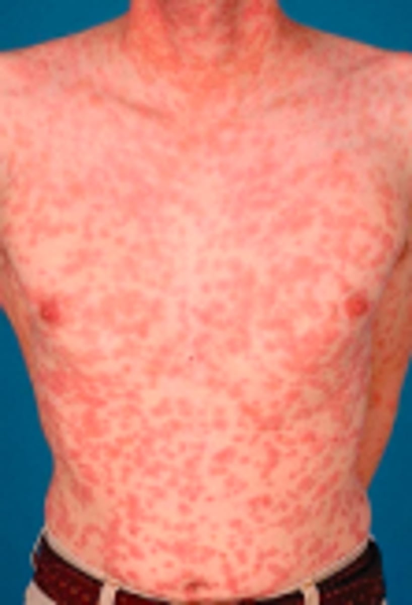 <p>Bacterial ID:</p><p>Subjective:</p><p>- Weeks-months after chancre develops if untreated</p><p>- Not ALWAYS have history of preceding chancre due to asymptomatic/unnoticed primary infection</p><p>- Acute manifestations typically resolve spontaneously</p><p>Constitutional symptoms:</p><p>- Fever, headache, malaise, anorexia, sore throat, myalgias, weight loss</p><p>Rash:</p><p>Widespread rash that is occasionally pruritic</p>