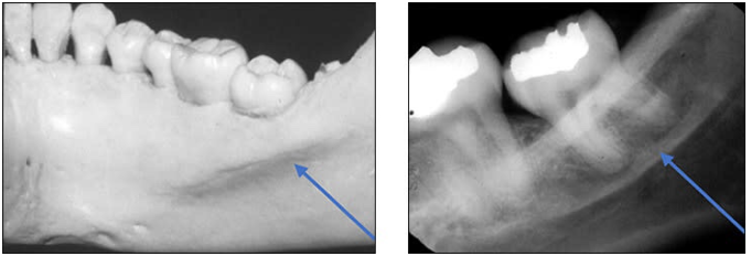<p>Mylohyoid ridge</p><ul><li><p>linear prominence of bone located on the internal surface of the mand</p></li><li><p><u>Radiography:</u><strong><u> dense radiopaque band</u></strong><u> that extends downwards and forward from the molar region.</u></p></li></ul><p></p>