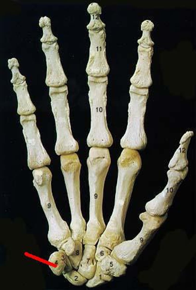 <p>Pisiform of carpal</p>