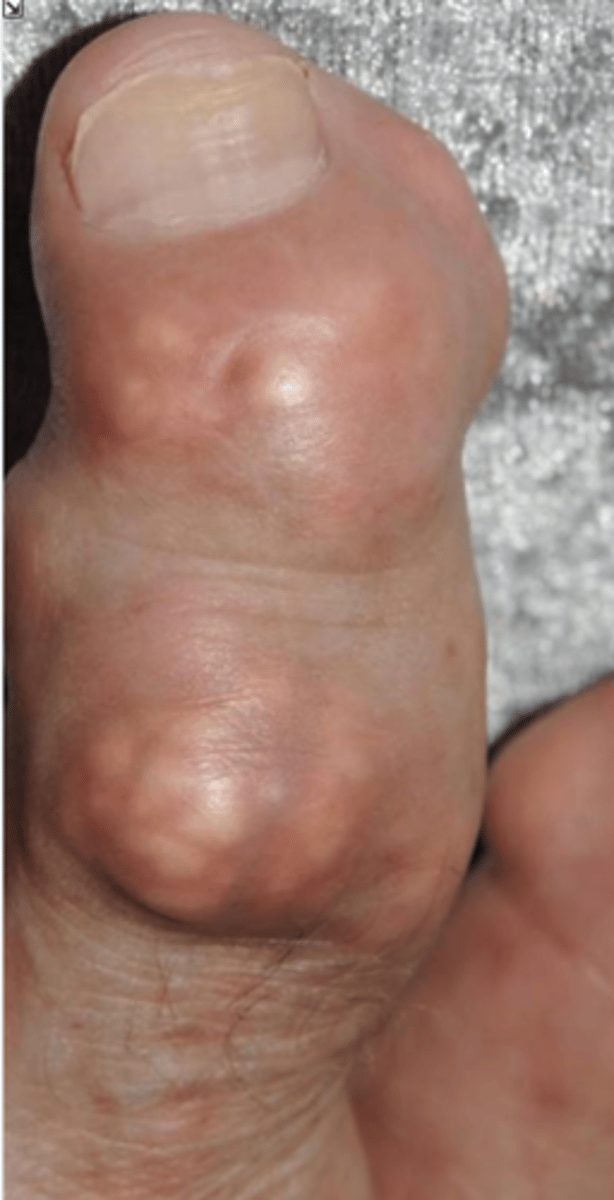 <p>State the lab findings of gout</p>