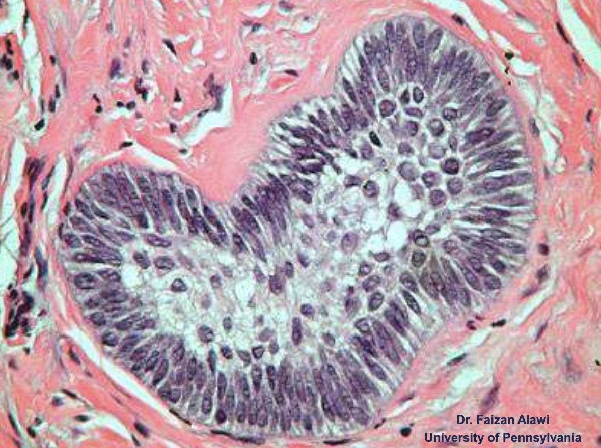 <ul><li><p>nests of epithelium </p></li><li><p>island centers resembling stellate reticulum</p></li><li><p>peripheral columnar cells with nuclei polarized opposite basement membrane (sub-nuclear vacuolization)</p></li><li><p>mature fibrous background</p></li></ul><p></p>