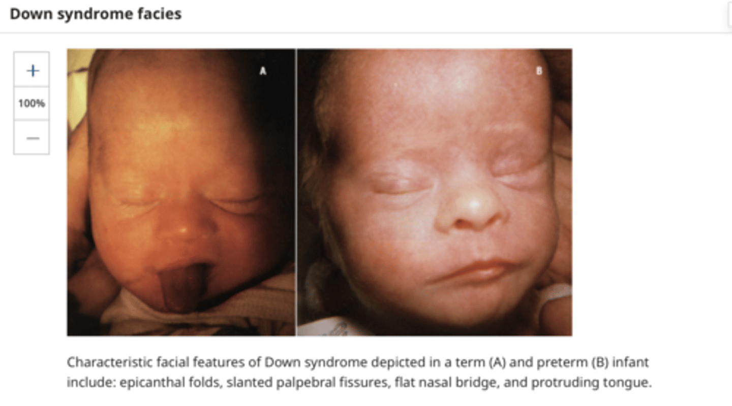 <p>Symmetry ‒ Asymmetry of the eyes may be the result of prominent epicanthal folds (skin folds over the medial aspect of the eyes), a difference in the size of the globes, or ptosis. Epicanthal folds are rarely normal and usually suggest a syndrome (eg, trisomy 21)</p>