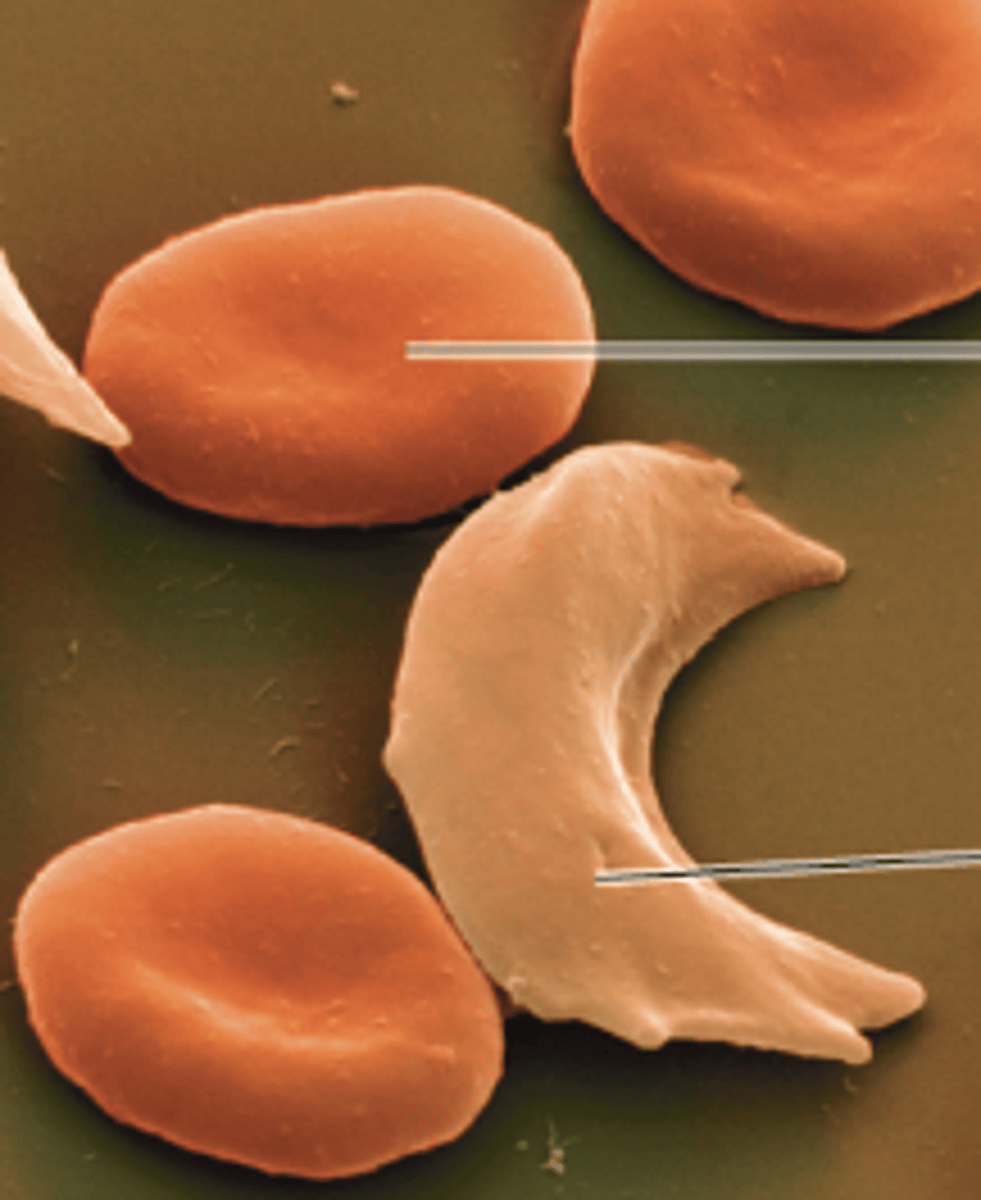 <p>sickle-cell disease</p>