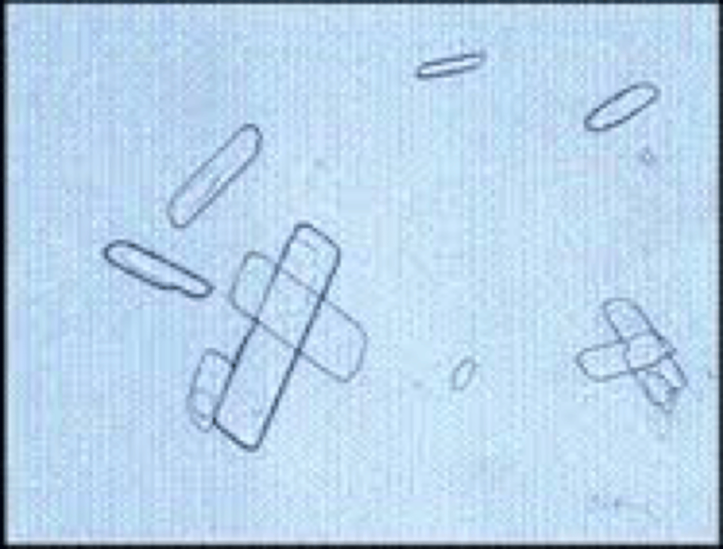 <p>- similar to cholesterol crystals, polarize<br>- patient history<br>- very high SG with refractometer</p>