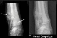 <ul><li><p>A bone disease in fast-growing large and giant breed dogs, first presents between 2-7 months old.</p></li><li><p>marked by decreased blood flow to the metaphysis → failure of ossification → resulting in necrosis and inflammation of cancellous bone (spongiosis). </p></li><li><p>usually bilateral in limb bones. </p></li><li><p><strong>Diagnosis:</strong> history, symptoms, physical exam with pain + swelling on growth plates and ex-rays. </p><ul><li><p><mark data-color="#f3c9de" style="background-color: #f3c9de; color: inherit">X-ray: thin radiolucent (dark) line at metaphysis (growth plate) in end of ulna, radius or tibia. </mark></p></li><li><p>bony inflammation and bone remodelling may be seen, fever + hgih WBC count.</p></li></ul></li><li><p><strong>Treatment:</strong> supportive, anti-inflammatories, painkillers (carprofen). </p></li></ul><p></p>
