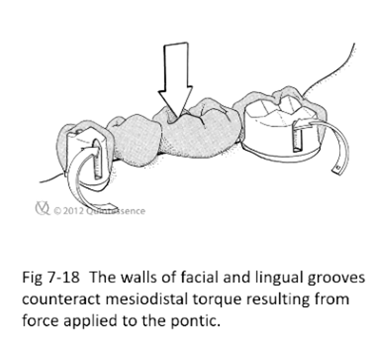 <p>create facial and lingual mechanical grooves to counteract M-D torque</p>