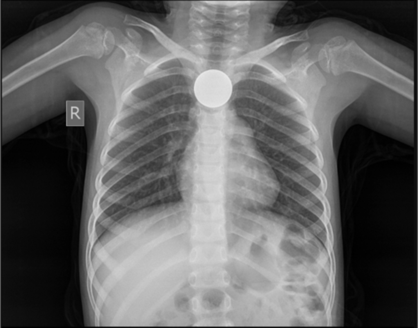 <p>Define radiopaque foreign objects?</p>