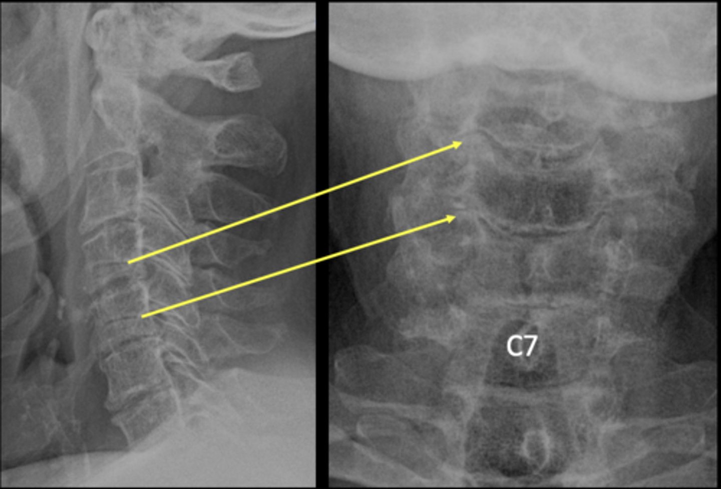 <p>Which levels are you expecting uncinate hypertrophy to be on the AP lower cervical?</p>