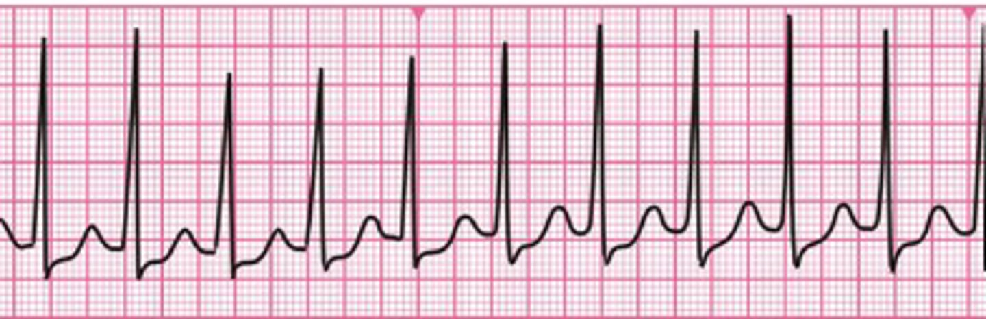 <p>Sleglahraðtakti (ventricular tachycardiu) (Stuðar við því)</p>
