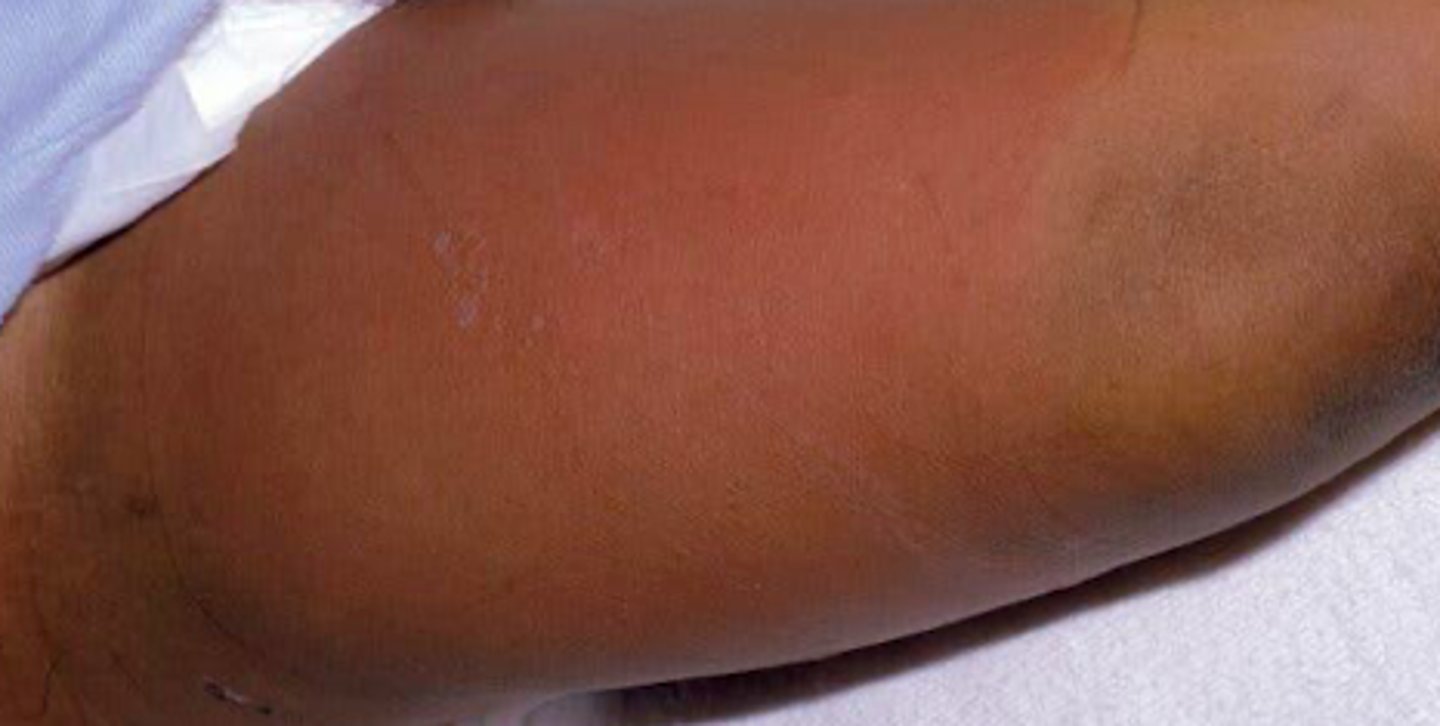 <p>Bacterial Skin Infections:</p><p>If a patient presented with the following S/S, what may we suspect they have:</p><p>-effecting dermal and SQ layer</p><p>- prodrome of malaise, anorexia, fever</p><p>- blanchable, non bilateral acute infection</p><p>- erythema, warmth, and edema of 1 portion of skin; not very well-demarcated</p><p>- pain &amp; tenderness at the site</p>