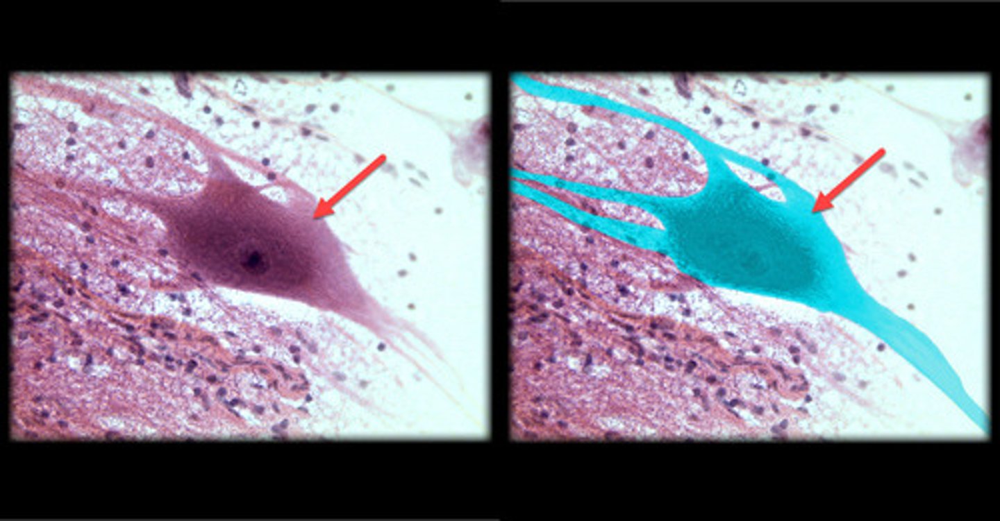 <p>- Large, star-shaped cells with multiple processes (dendrites) radiating from the cell body and a single, long axon.</p><p>- The cell body (soma) contains a prominent nucleus and a nucleolus.</p><p>- Appear with a clearly defined soma, multiple branching dendrites, and a single axon extending away from the cell body.</p><p>- Found in the brain, spinal cord, and peripheral nerves, these are the most common type of neurons in the nervous system.</p>