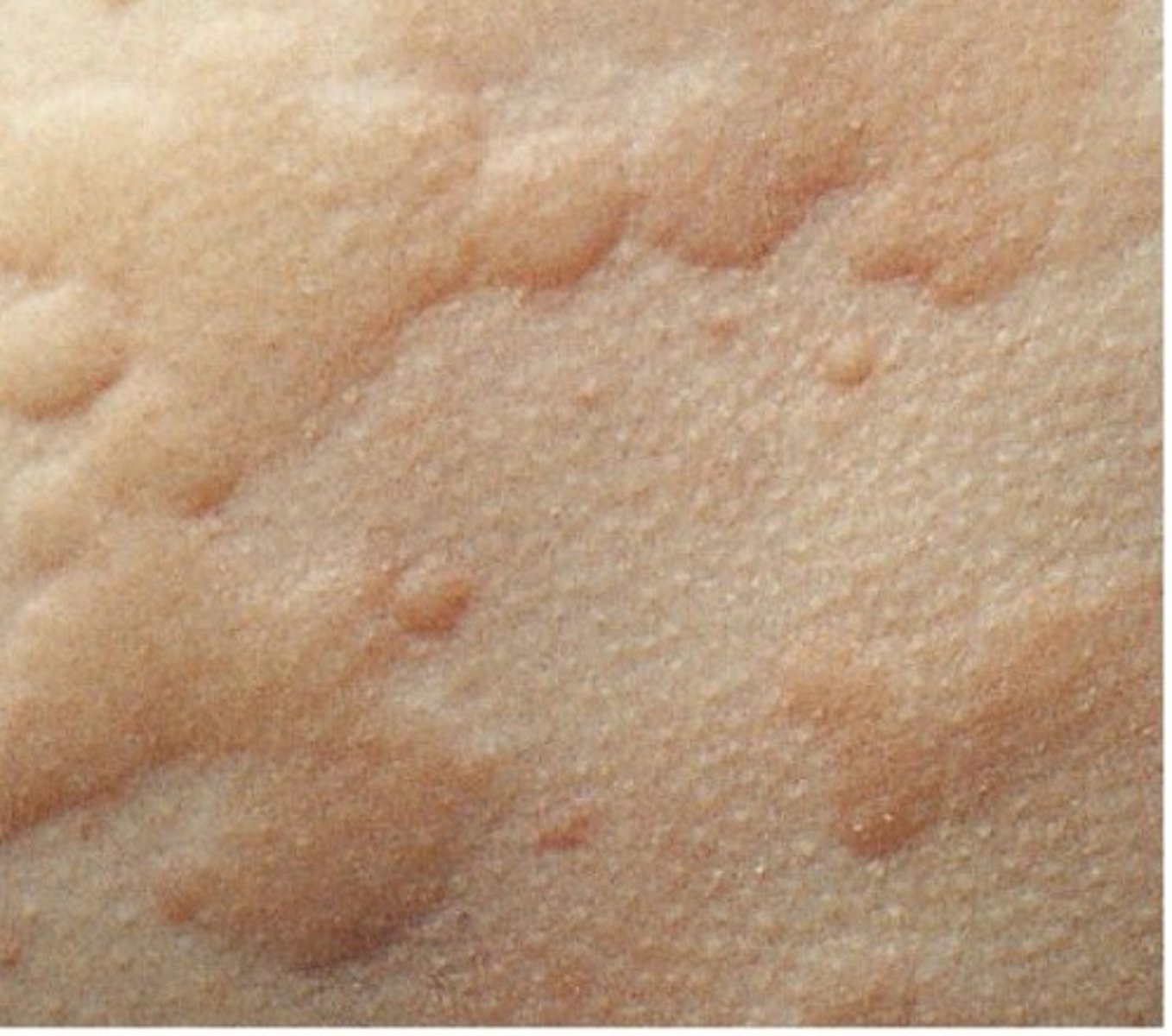 <p>Red, itchy, possibly raised blotches on the skin that often result from allergic reactions; Look at the location of the rash; the first step is to determine the need for epinephrine; Look for respiratory symptoms, difficulty breathing, hoarseness; look at location of rash; is it on the neck, around the face, etc.; if it is, epinephrine must be administered</p>